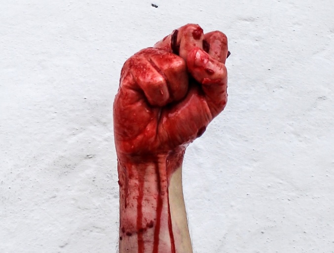 Bloody Fist Of Abortion Activism Bloody Fist Of Abortion Activism